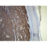 IHC-P analysis of diffuse Melan A positivity in the cutaneous malignant melanoma (4 µm section).