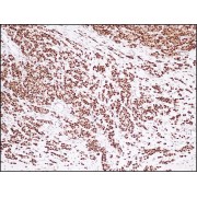 IHC-P analysis of diffuse and strong estrogen receptor expression in mucinous breast carcinoma (4 µm section).