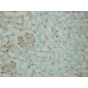 IHC-P analysis of transplanted kidney tissue (4 µm section) stained with anti-C4d complement antibody, showing diffuse strong positive immunostaining of peritubular and glomerular capillaries, indicating acute antibody mediated rejection.