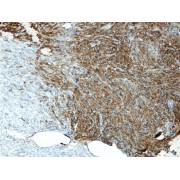 IHC-P analysis showing focal CD34 positivity in the gastrointestinal stromal tumor (GIST) of small intestine (4 µm section).