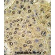 IHC analysis of formalin-fixed and paraffin-embedded human hepatocarcinoma tissue using HIF1 alpha antibody, with DAB staining.