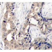 IHC-P analysis of Human breast carcinoma, using ABL1 (pY412) Antibody (abx000351).