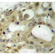Immunohistochemistry of paraffin-embedded human breast carcinoma using Phospho-AR-S650 antibody (abx000355).