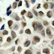 Immunohistochemistry of paraffin-embedded human lung carcinoma using Phospho-HDAC8-S39 antibody (abx000408).