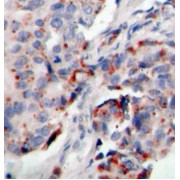 Immunohistochemistry of paraffin-embedded human breast carcinoma tissue, using Phospho-JAK2-Y221 antibody (abx000422).