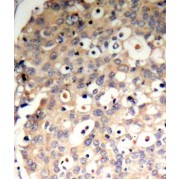 Immunohistochemistry of paraffin-embedded human breast carcinoma tissue, using Phospho-PTPN6-Y536 antibody (abx000487).