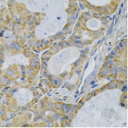 Immunohistochemistry of paraffin-embedded human thyroid cancer using TLR7 Antibody (abx000944) at dilution of 1/100 (40x lens).