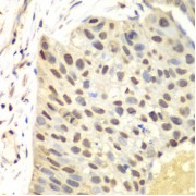 Immunohistochemistry of paraffin-embedded human lung cancer using FEN1 antibody (abx001089) at dilution of 1/100 (40x lens).