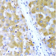 Immunohistochemistry of paraffin-embedded human liver cancer using TIRAP antibody (abx001586) at dilution of 1/200 (40x lens).