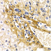 Immunohistochemistry of paraffin-embedded human liver injury using CFH antibody (abx001778) at dilution of 1/200 (40x lens).