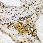 Immunohistochemistry of paraffin-embedded human colon carcinoma using IFIH1 antibody (abx001815) at dilution of 1/200 (40x lens).