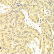 Immunohistochemistry of paraffin-embedded human thyroid cancer using CFLAR antibody (abx001992) at dilution of 1/100 (40x lens).