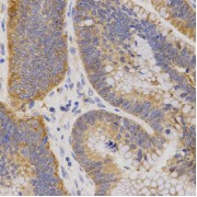 Immunohistochemistry of paraffin-embedded human rectal cancer using P2RY11 antibody (abx002207) at dilution of 1/200 (40x lens).