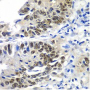 Immunohistochemistry of paraffin-embedded human colon carcinoma using DACH1 antibody (abx002773) at dilution of 1/100 (40x lens).