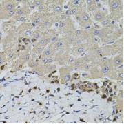 Immunohistochemistry of paraffin-embedded human liver injury using S100A12 antibody (abx004073) at dilution of 1/100 (40x lens).