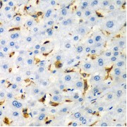 Immunohistochemistry of paraffin-embedded human liver injury using CD68 antibody (abx006824) at dilution of 1/100 (40x lens).