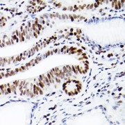 Immunohistochemistry of paraffin-embedded human colon carcinoma tissue, using MCL1 antibody (1/100 dilution, 40x lens).