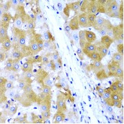 Immunohistochemistry analysis of paraffin-embedded Human liver cancer using TIRAP Antibody at dilution of 1/200 (40x lens). Microwave antigen retrieval performed in 0.01 M PBS Buffer (pH 7.2) prior to IHC staining.