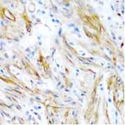 Immunohistochemistry analysis of paraffin-embedded Human colon using LMOD1 Antibody at dilution of 1/200 (40x lens). Microwave antigen retrieval performed in 0.01 M PBS Buffer (pH 7.2) prior to IHC staining.