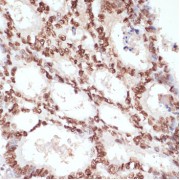 Immunohistochemistry analysis of paraffin-embedded Human colon carcinoma using Phospho-β-Catenin-S33/S37/T41 Antibody at dilution of 1/100 (40x lens). Microwave antigen retrieval performed in 0.01 M Tris/EDTA Buffer (pH 9.0) prior to IHC staining.