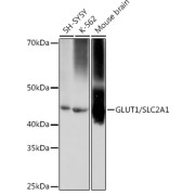 Immunohistochemistry analysis of paraffin-embedded Human lung squamous carcinoma tissue using GLUT1/SLC2A1 Rabbit antibody at a dilution of 1/800 (40x lens). High pressure antigen retrieval performed in 0.01 M Tris-EDTA Buffer (pH 9.0) prior to IHC staining.
