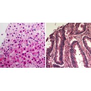 Immunohistochemical staining of human liver carcinoma and human colon carcinoma formalin-fixed paraffin-embedded tissue, using AEC Chromogen Kit. The section was then counterstained with hematoxylin and mounted with neutral gum.