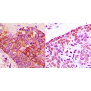 Immunohistochemical analysis staining in human breast carcinoma formalin fixed paraffin-embedded tissue section, using DAB Chromogen Kit. The section was then counterstained with haematoxylin and mounted with Neutral Gum.