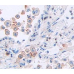Transcobalamin II, Macrocytic Anemia (TCN2) Antibody