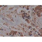 IHC-P analysis of Human Breast cancer Tissue, with DAB staining.