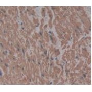 IHC-P analysis of Human Stomach Cancer Tissue, with DAB staining.