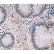 IHC-P analysis of Rat Rectum Cancer Tissue, with DAB staining.