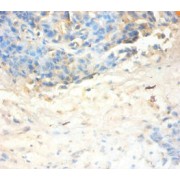 Immunohistochemistry of paraffin-embedded human ovarian cancer using SLPI antibody at dilution of 1/100
