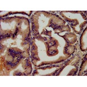 Immunohistochemistry analysis of paraffin-embedded Human prostate tissue using Lactoferrin (LTF) Antibody (1/450 dilution, 1% BSA, 4°C overnight) and biotinylated secondary antibody, visualised using an HRP-conjugated SP system. High pressure antigen retrieval was carried out in citrate buffer, pH 6.0, and sample was blocked with normal goat serum (30 min, RT) prior to staining.