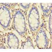 IHC-P analysis of Human colon cancer, using RHBDL2 antibody (1/100 dilution).