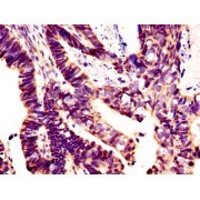 IHC-P analysis of Human ovarian cancer tissue, using Zinc Finger Protein GLI1 (GLI1) antibody (1/400 dilution) followed by a biotin-conjugated secondary antibody.