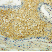 IHC-P analysis of human osteosarcoma.