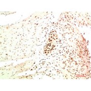 Immunohistochemistry analysis of paraffin-embedded Human Colon Carcinoma Tissue using HP-1 α Mouse mAb diluted at 1/200.