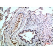 Immunohistochemistry analysis of paraffin-embedded Human Lung Carcinoma Tissue using P38 Mouse mAb diluted at 1/200.