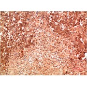 Immunohistochemistry analysis of paraffin-embedded Human Lung Carcinoma Tissue using P38 Mouse mAb diluted at 1/200.