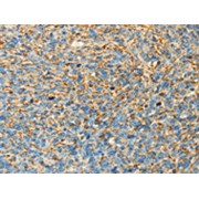 IHC-P analysis of Human ovarian cancer tissue, using APOA4 Antibody (1/30 dilution, original magnification 200X).