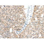 IHC-P analysis of Human ovarian cancer tissue, using Mitogen-Activated Protein Kinase Kinase Kinase 14 (MAP3K14) antibody (1/30 dilution, x200 lens), treated with the corresponding fusion protein.