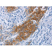 IHC-P analysis of Human esophagus cancer tissue, using CCR9 Antibody (1/60 dilution, X200 lens).
