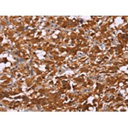 IHC-P analysis of Human thyroid cancer tissue, using DCBLD2 Antibody (1/50 dilution, x200 lens).
