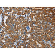 IHC-P analysis of Human thyroid cancer tissue, using FLCN antibody (1/40 dilution, x200 lens).