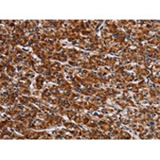IHC-P analysis of human prostate cancer tissue, using LRRC15 Antibody (1/60 dilution, 200x magnification).