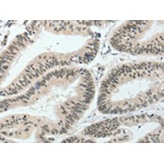 IHC-P analysis of human colon cancer tissue, using HNF1B Antibody (1/80 dilution, 200x magnification).