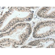 IHC-P analysis of human colon cancer tissue, using HNF1B Antibody (1/80 dilution, 200x magnification).