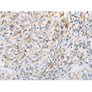 Immunohistochemistry analysis of paraffin-embedded Human gastric cancer tissue using C-Type Natriuretic Peptide Antibody (1/70 dilution, 200x magnification).