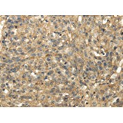 IHC-P analysis of human breast cancer tissue, using TACSTD2 antibody (1/35 dilution, original magnification 200X).