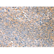 IHC-P analysis of Human esophagus cancer tissue using PRSS8 antibody (1/45 dilution, X200).